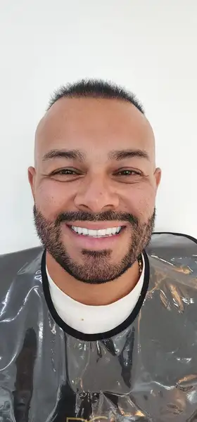 Después - Carillas de cerámica