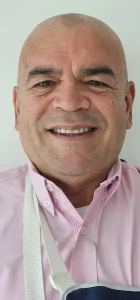 Antes - Carillas y coronas de porcelana