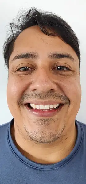 Antes - Carillas de resina