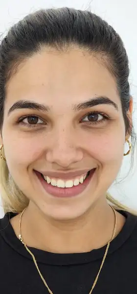 Antes - Microdiseño de sonrisa