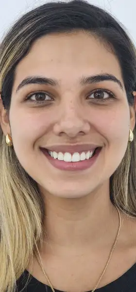 Después - Microdiseño de sonrisa